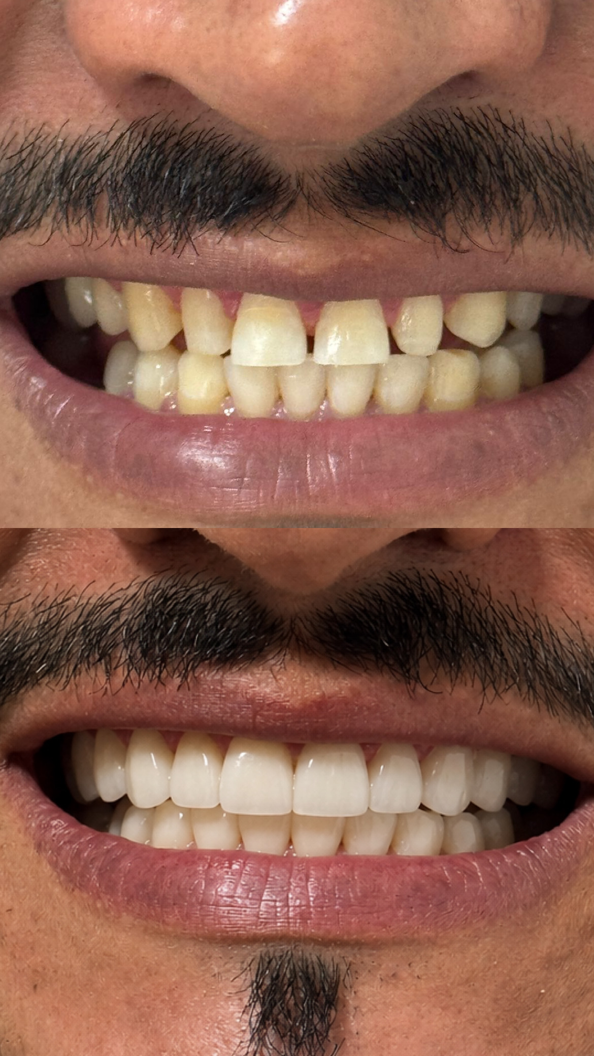 Antes e depois de tratamento estético realizado pela OdontoMAP
